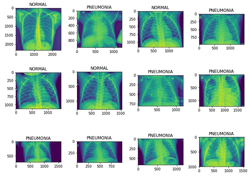 Efficient Deep Learning Approach for the Classification of Pneumonia in ...